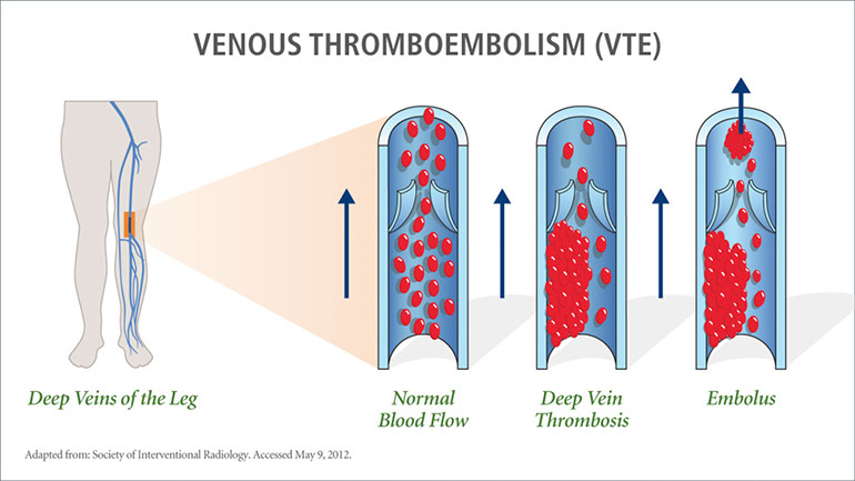 %_tempFileNameDeep%20Vein%20Thrombosis%20drawing%